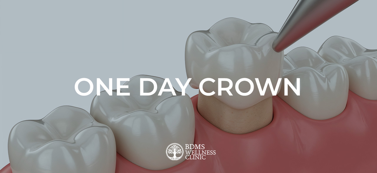 One-Day Crowns in Bangkok
